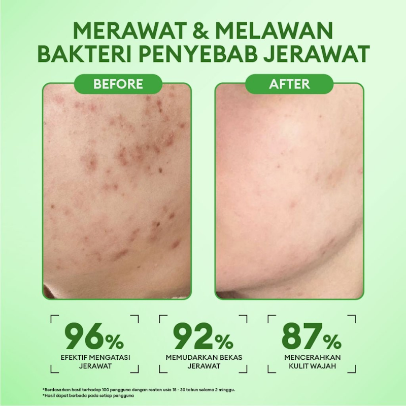 Animate Intense Acne Solution Night Cream 4