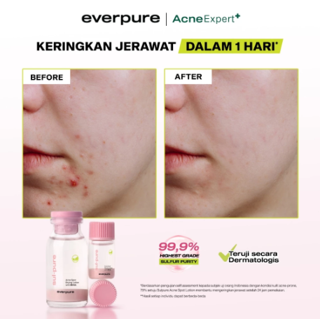 Everpure Sul-pure Acne Spot Drying Lotion with BHA