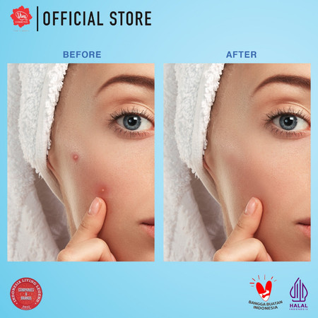 Viva Acne Gel Triple Action