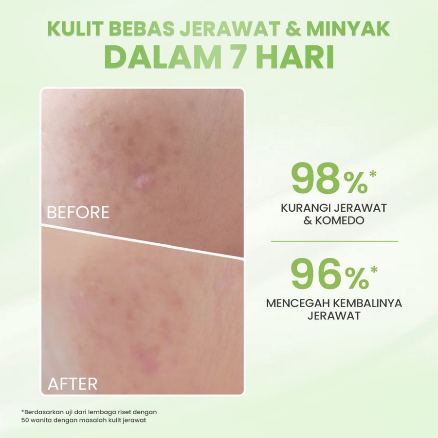 Eka Jaya Internasional Hanasui Acne Expert Essence
