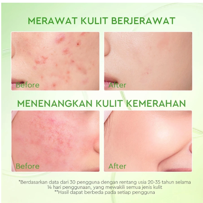 Suntone Wisdom Indonesia Glad2Glow Kiwi 3D Acid Acne Moisturizer