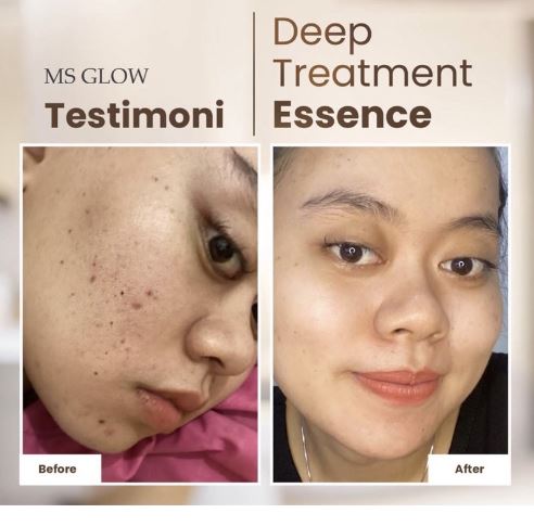 Kosmetika Cantik Indonesia MS Glow Deep Treatment Essence Salmon DNA