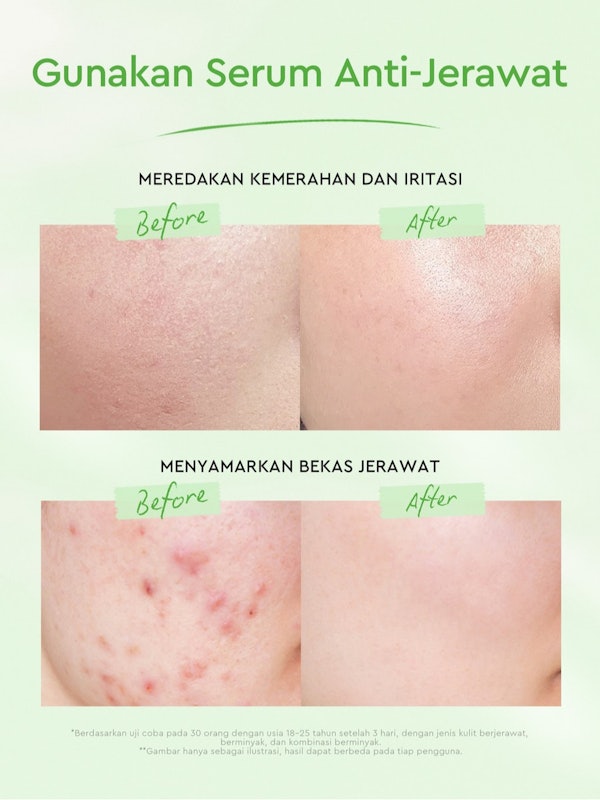 Glad2Glow Centella Salicylic Acid Power Acne Serum 4