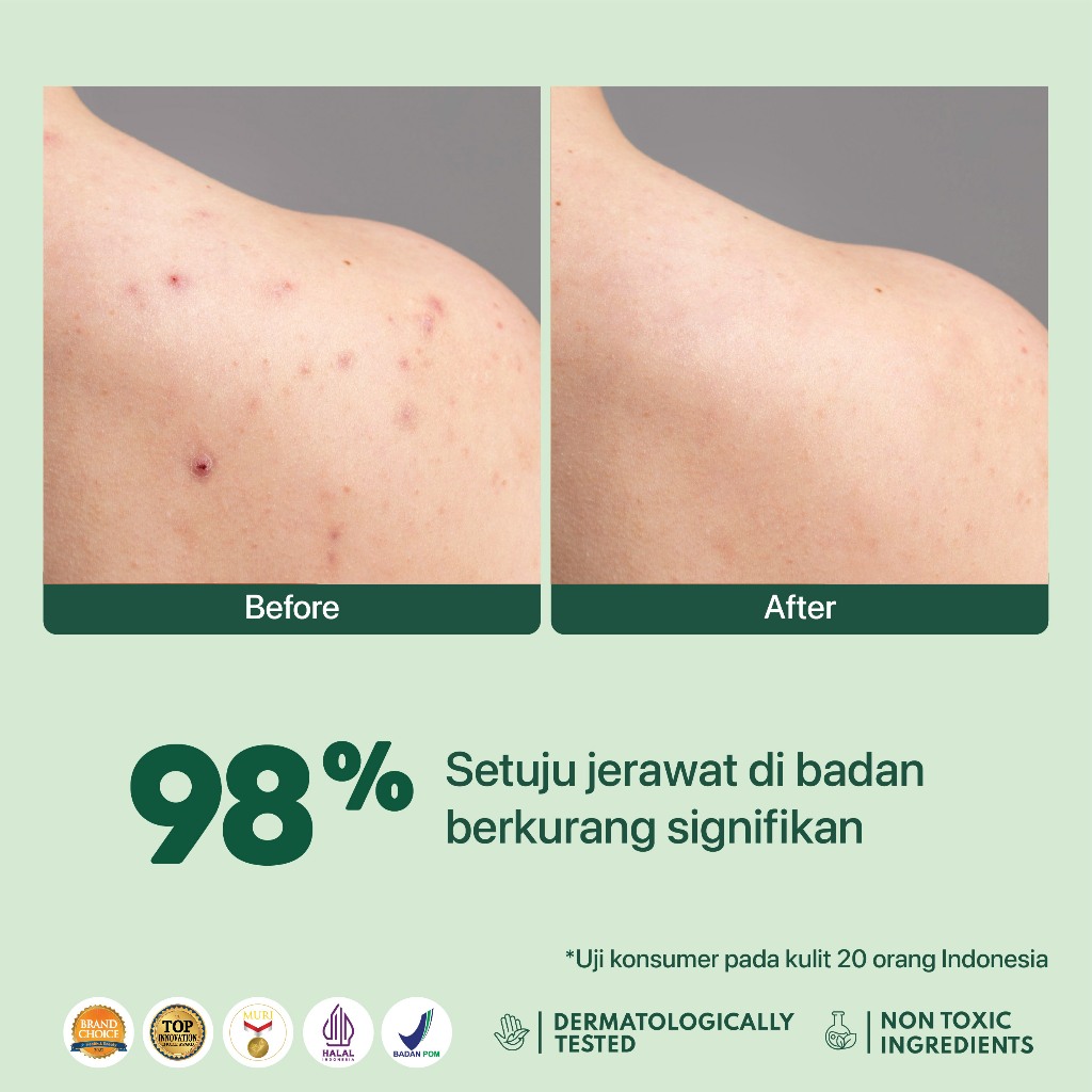 Penta Natural Kosmetindo N'PURE CICA Bacne+ Acne Clear Body Spray