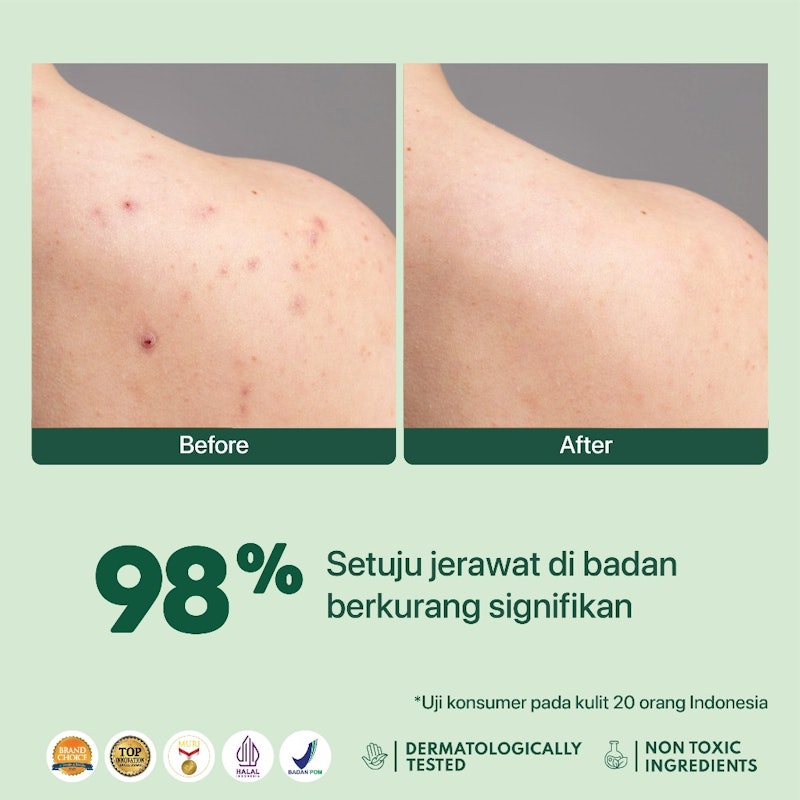 CICA Bacne+ Acne Clear Body Spray 5