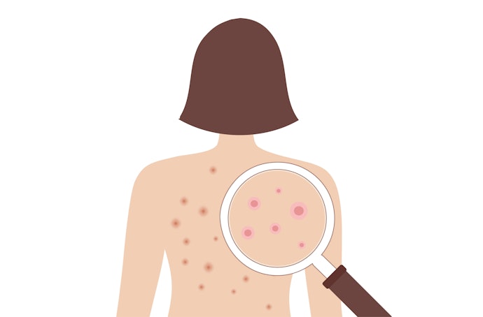 Jika Anda punya permasalahan jerawat badan, pilih sabun batang antiseptik atau cari yang mengandung sulfur, salicylic acid, tea tree oil, Aloe vera, dan benzoyl peroxide
