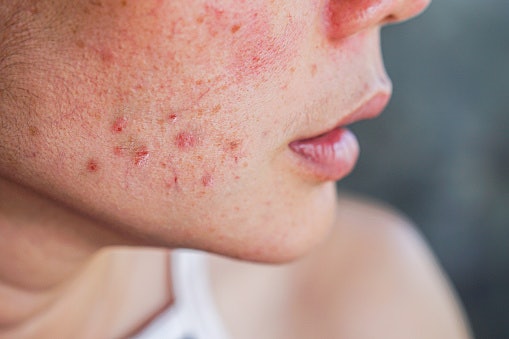 Jika beruntusan terjadi karena peradangan jerawat, temukan produk dengan kandungan bahan antibakteri misalnya tea tree oil dan Centella asiatica