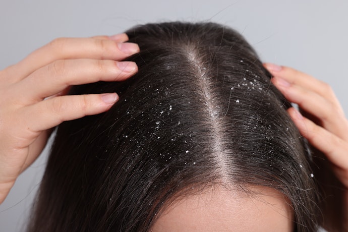 Jika rambut berminyak disertai ketombe, pilihlah shampo anti ketombe untuk mengatasinya
