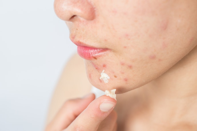 Jika ingin mengatasi masalah kulit di area tertentu, pilih spot treatment