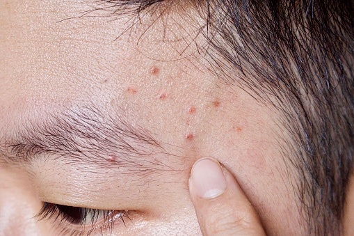 Jika kulit masih didominasi jerawat aktif dan komedo, utamakan masker dengan kandungan salicylic acid (BHA) dan niacinamide saja