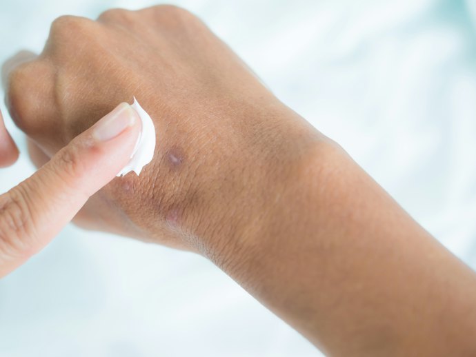 Untuk bekas luka yang memutih, seperti bekas cacar atau panu, utamakan untuk menggunakan pelembap yang mengandung antioksidan, seperti Aloe vera atau vitamin E