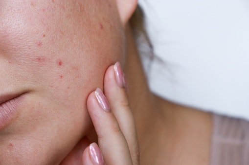 Atasi permasalahan jerawat dan komedo dengan varian Acne Solution, Oil Control, Clear Solution, dan Anti Bacterial