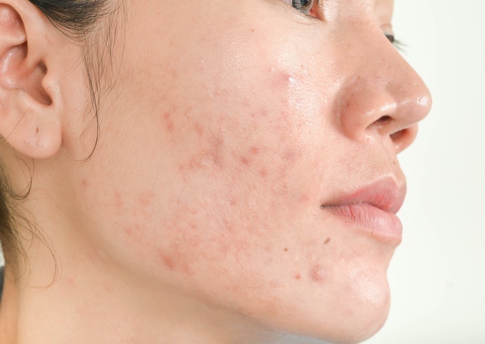 Untuk kulit kombinasi remaja yang biasanya rentan berjerawat, pilih essence yang mengandung bahan eksfoliasi, seperti AHA dan BHA