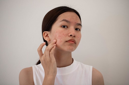 Bila kulit mengalami jerawat meradang dan komedo, pilih clay mask dengan kandungan salicylic acid, willow bark, tea tree oil, mugwort, atau Centella asiatica
