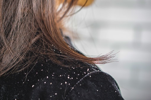Bila rambut kering disertai dengan ketombe, prioritaskan shampoo yang hypoallergenic