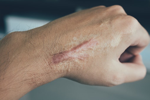 Keloid memang sulit untuk diatasi, tetapi kemunculannya dapat dicegah dengan salep yang mengandung silicone atau liposome