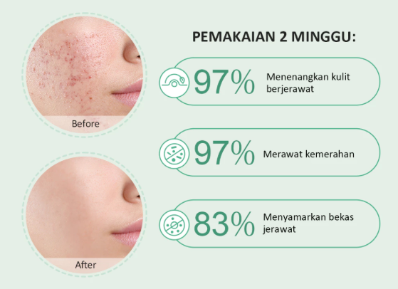 Pertimbangkan obat totol jerawat dengan tambahan niacinamide untuk mengatasi jerawat dan bekasnya