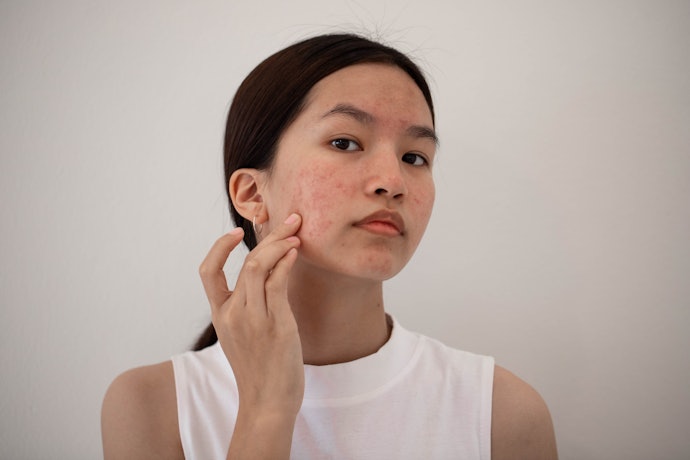 Jika Anda punya jerawat aktif dengan tipe kulit berminyak, sebaiknya hindari penggunaan sleeping mask