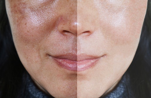 Bagi Anda yang tampilan pori-porinya disebabkan oleh penuaan kulit, carilah masker yang mengandung bahan anti-aging