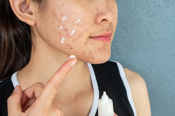 Untuk kulit berminyak dan berjerawat, pilih pelembap water-based yang ringan dengan kandungan witch hazel dan tea tree oil sebagai efek anti-inflamasi