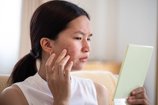 Jika kulit Anda berminyak dan berjerawat, utamakan hydrating toner cica dengan niacinamide, tea tree oil, atau zinc oxide serta exfoliating toner yang mengandung salicylic acid