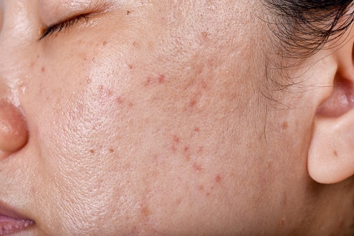 Bila Anda berjerawat, cek yang mengandung antioksidan dan antibakteri, contohnya vitamin E dan madu