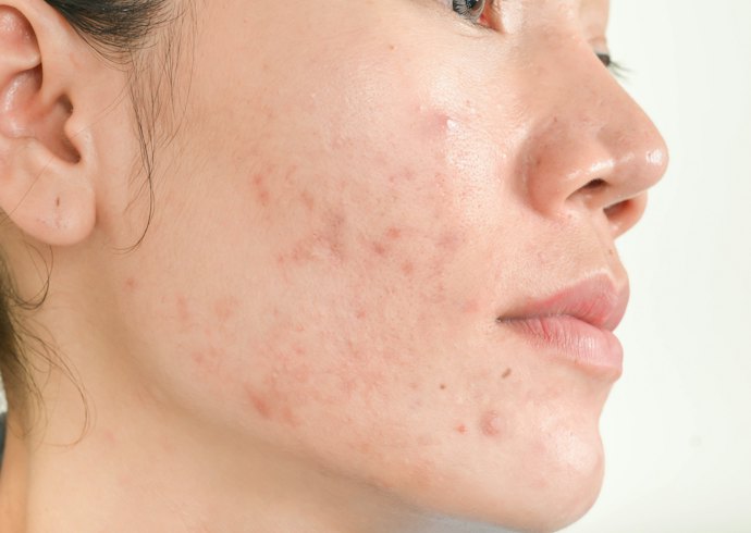 Kulit berjerawat Anda juga punya bekas jerawat? Pertimbangkan clay mask dengan tambahan kandungan niacinamide