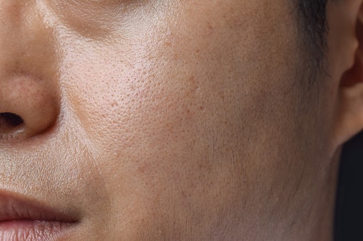 Jika bermasalah dengan kulit berminyak, pastikan sabun zaitunnya mengandung sebum controller, seperti vitamin A atau hyaluronic acid