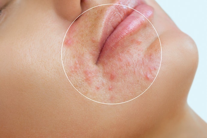 Untuk kulit sensitif yang berminyak, cari sabun muka yang mengandung zinc atau salicylic acid; Benzoyl peroxide bisa dipilih jika kulitnya berjerawat meradang