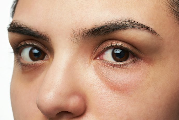 Jika kantung mata akibat pembengkakan: Temukan kandungan antioksidan serta soothing agent