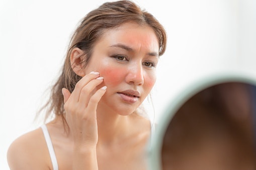 Bila kulit Anda sensitif, tenangkan dengan toner bebas alkohol dan pewangi yang mengandung hyaluronic acid, Aloe vera, atau chamomile extract