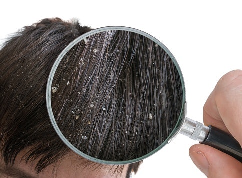 Kulit kepala berminyak dan berketombe: Cek ketersediaan bahan antimikroba seperti tea tree oil, rosemary extract, salicylic acid, dan lactic acid