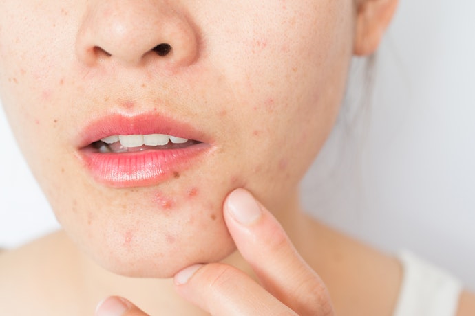 Bahan anti-inflamasi, merawat kulit yang kemerahan dan jerawat