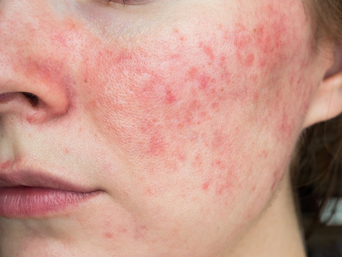 Untuk jerawat meradang dan luka: Pilih toner dengan kadar alkohol rendah 0% atau 5-10% yang mengandung salicylic acid