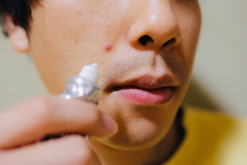 Krim jerawat: Paling ampuh mengatasi masalah minyak dan jerawat