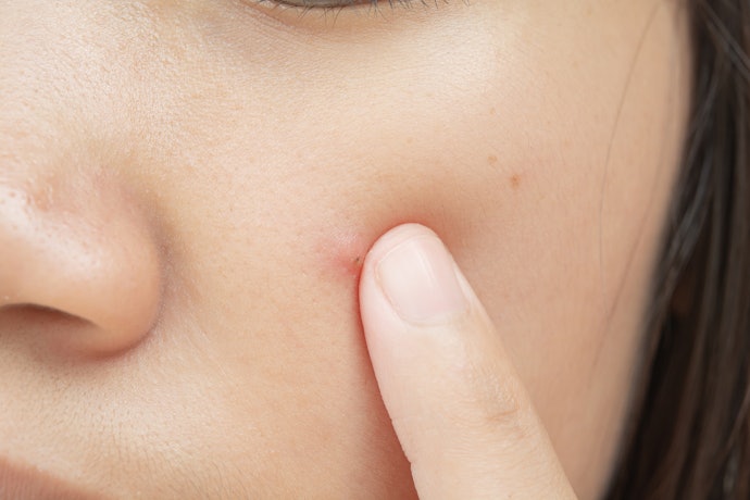 Apabila ada peradangan akibat jerawat atau iritasi, pertimbangkan tambahan anti-inflamasi