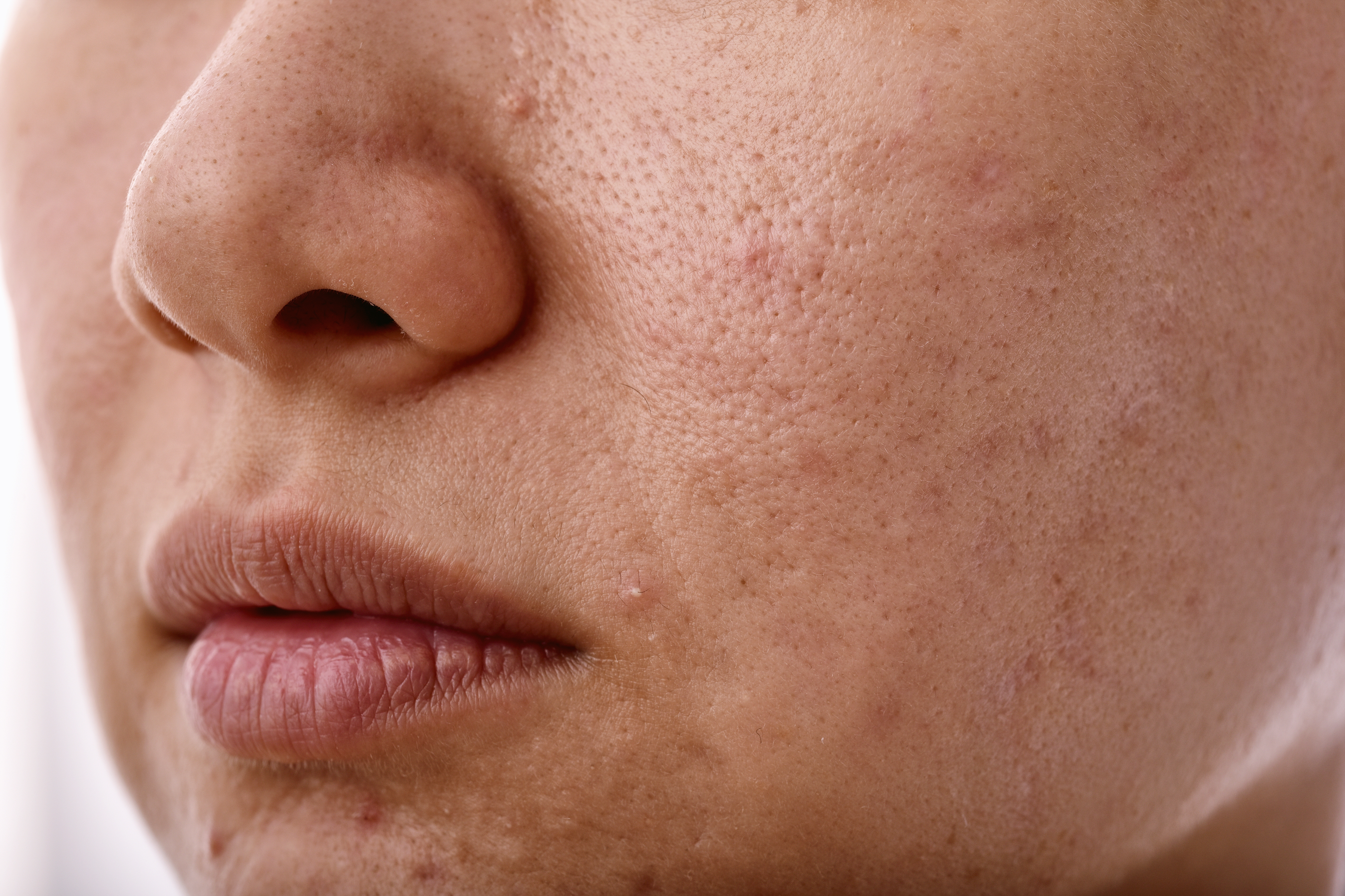 Untuk jerawat yang tidak aktif: Pilih toner yang mengandung AHA atau agen pencerah seperti alpha arbutin atau niacinamide