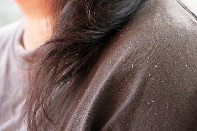 Bila ketombe sudah muncul, pilih hair creambath yang mengandung bahan anti-inflamasi, seperti kemiri atau menthol
