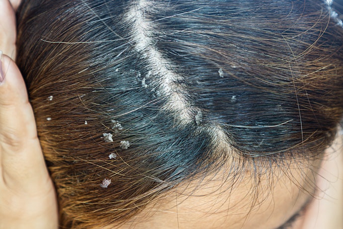 Untuk ketombe yang sudah bersisik tebal, prioritaskan penggunaan medicated shampoo