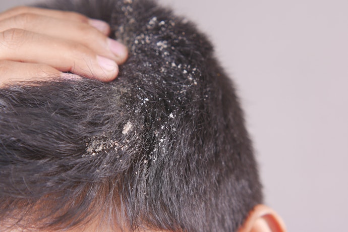 Untuk ketombe yang sudah menebal, prioritaskan penggunaan medicated shampoo