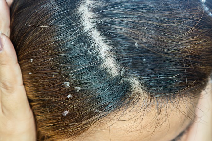 Untuk ketombe yang sudah bersisik tebal, prioritaskan penggunaan medicated shampoo