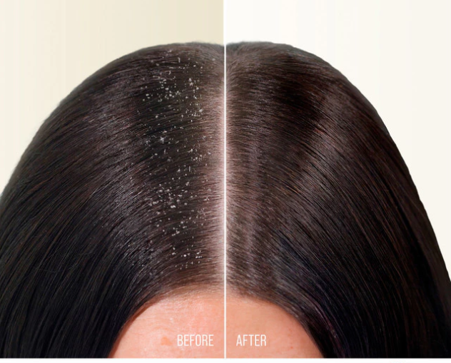 Bila rambut jadi rontok karena ketombe, fokus perbaiki masalah ketombe terlebih dahulu