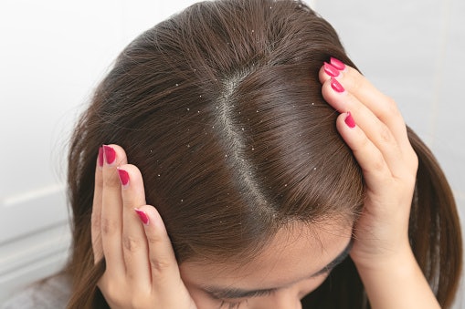Untuk kerontokan yang disebabkan oleh rambut berketombe, pilih shampoo antiketombe