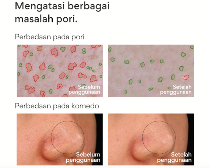 Untuk samarkan tampilan pori-pori, gunakan masker untuk cowok yang mengandung AHA, BHA, atau PHA