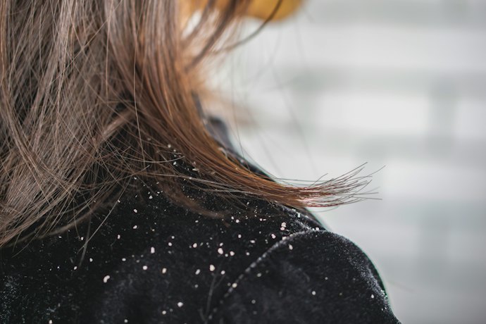 Bila ketombe sudah muncul; Gunakan bahan yang mengandung anti-inflamasi, seperti peppermint