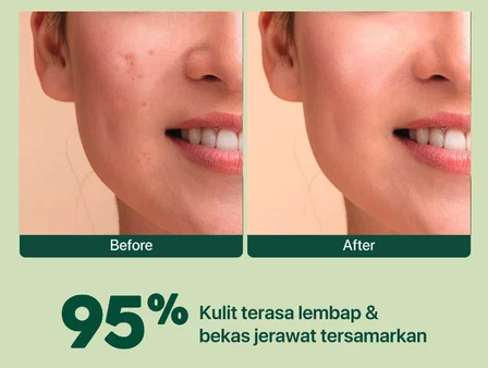 Kulit sensitif: Utamakan moisturizer cream dengan kombinasi humektan dan emolien