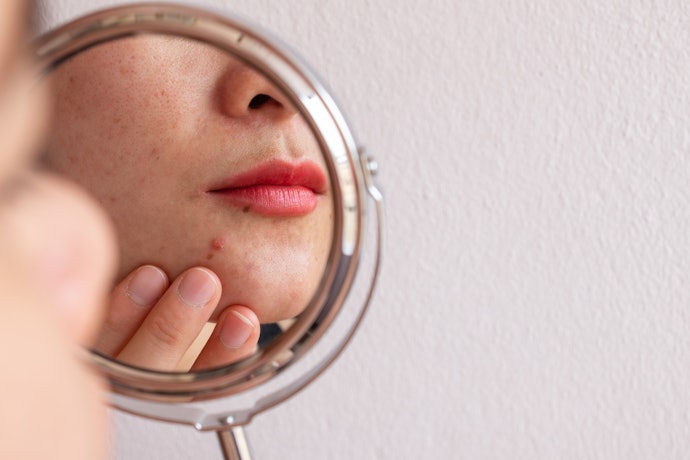 Untuk kulit sensitif karena jerawat, pilih yang mengandung niacinamide pada 10 komposisi awalnya