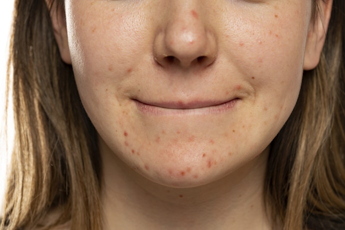 Jerawat meradang dan luka: Pastikan kandungan alkohol dalam toner rendah (5-10%) ditambah salicylic acid atau Aloe vera