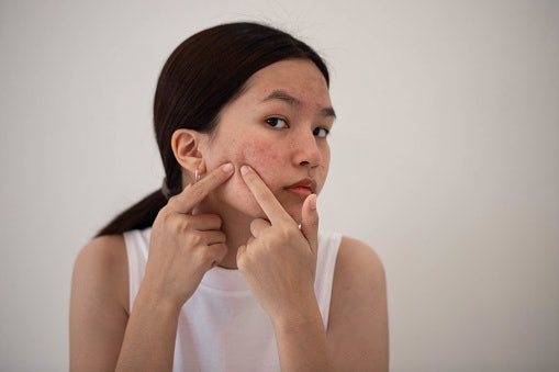 Namun, jika kulit sensitif Anda juga berjerawat, jangan pilih sleeping mask, gunakan krim malam saja