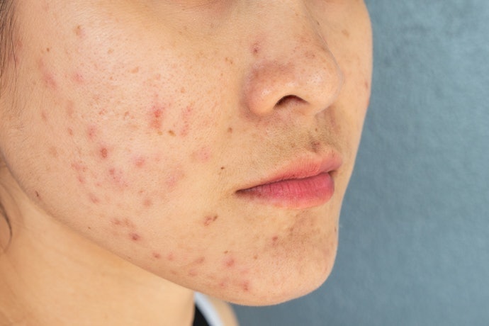 Untuk mengatasi jerawat: Pilih yang diperkaya bahan antibakteri, seperti salicylic acid dan tea tree oil